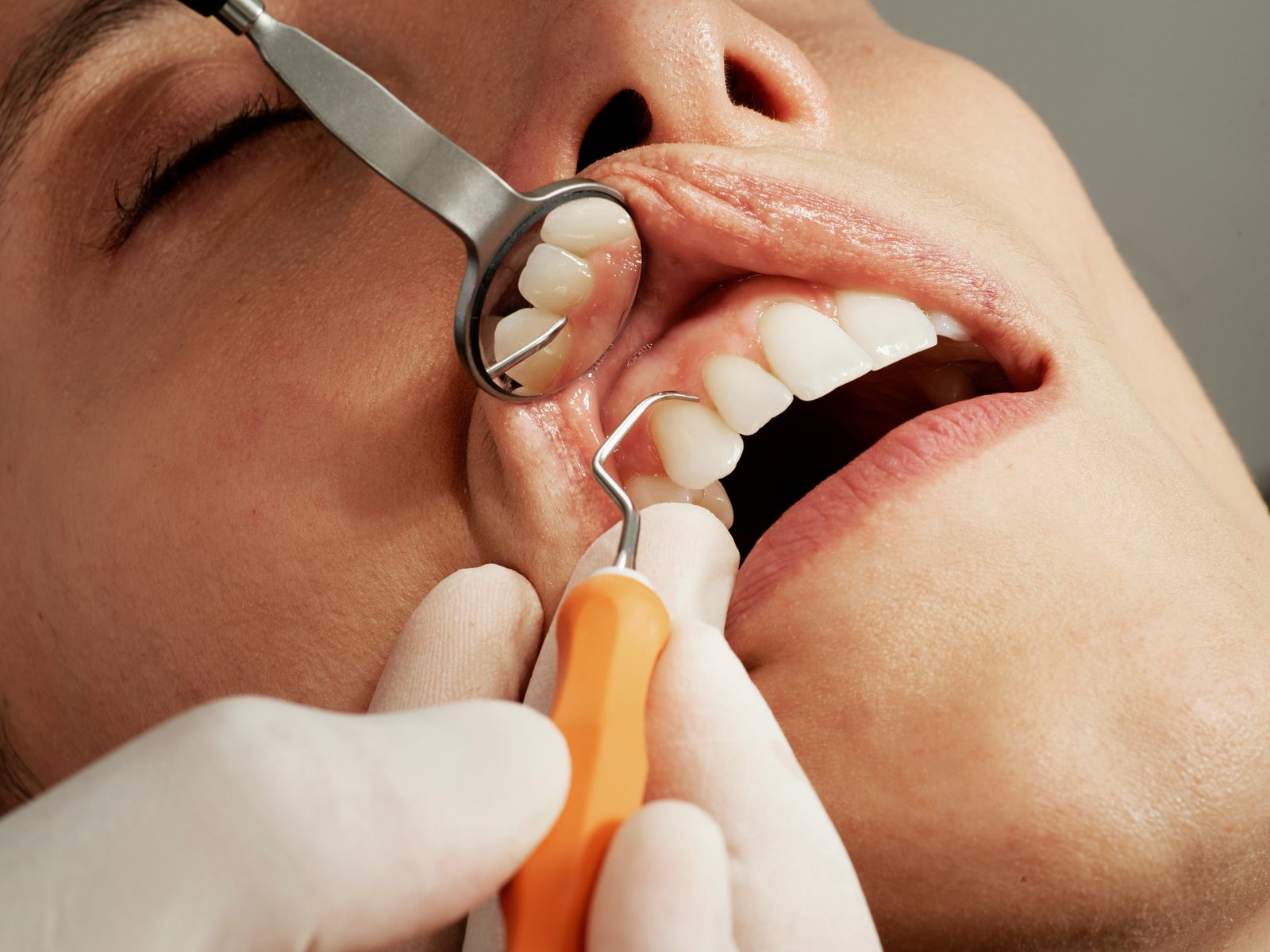 Dental Extraction