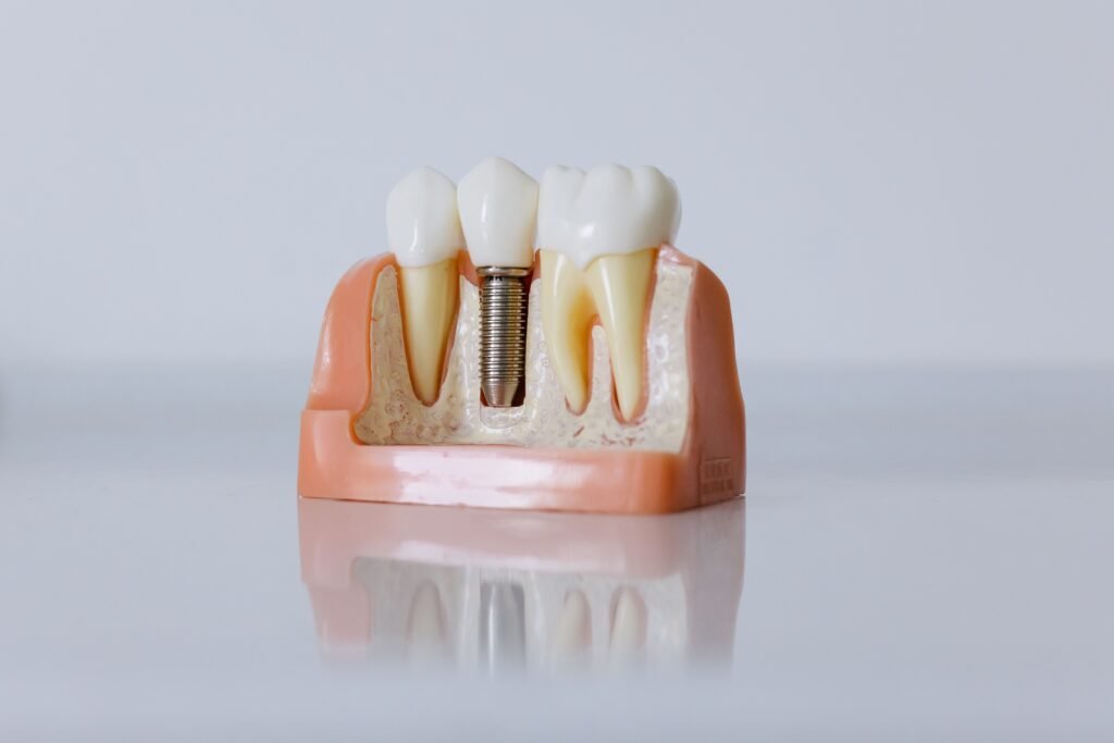 Implant Placement