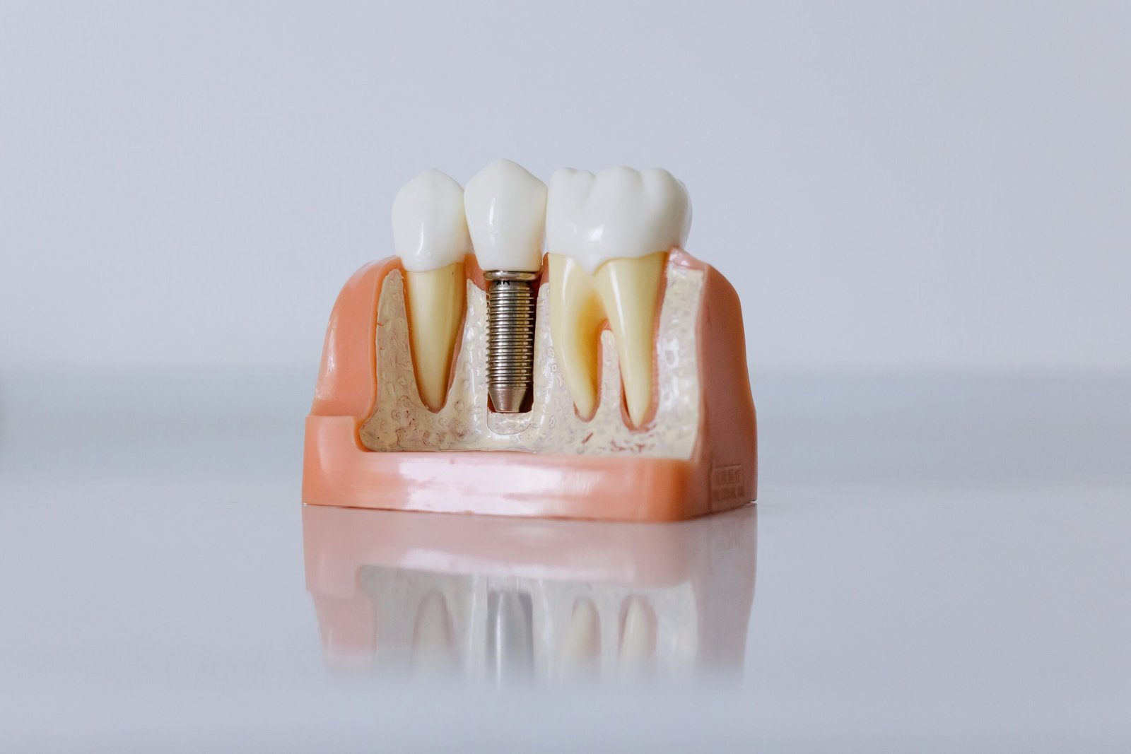 Implant Placement