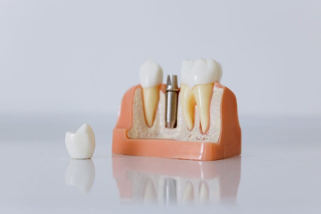 Implant Crown