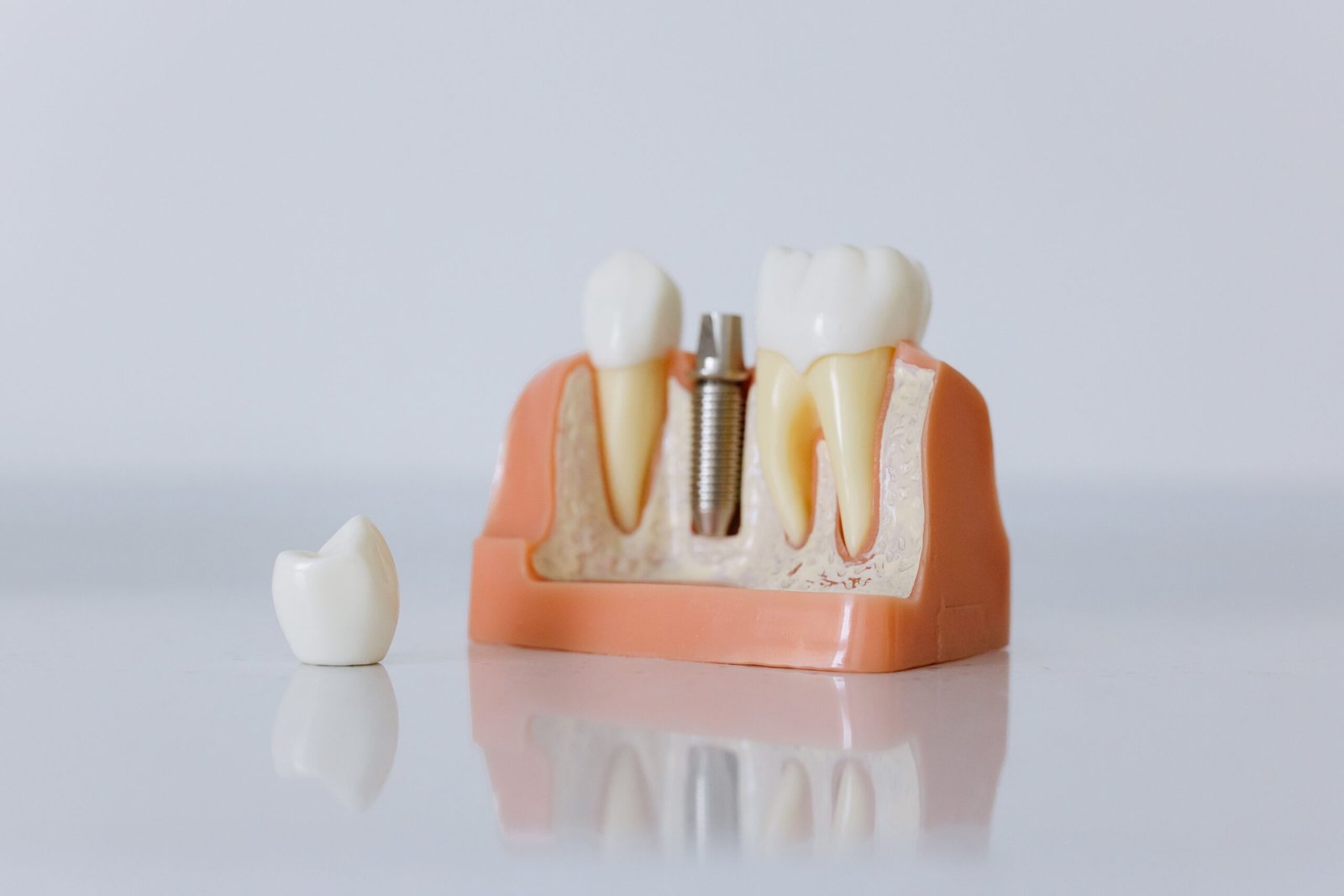 Implant Crown