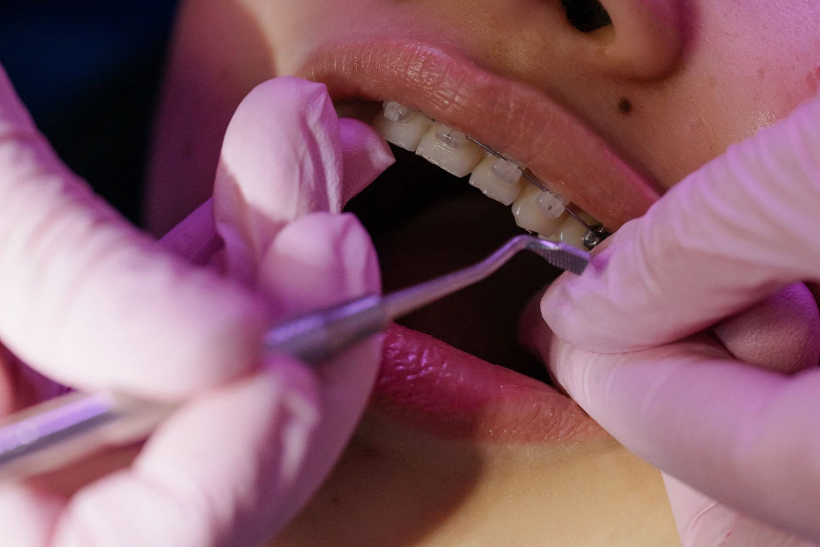 Ceramic Braces